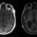 Investigadores identifican a un virus como detonador de la esclerosis múltiple