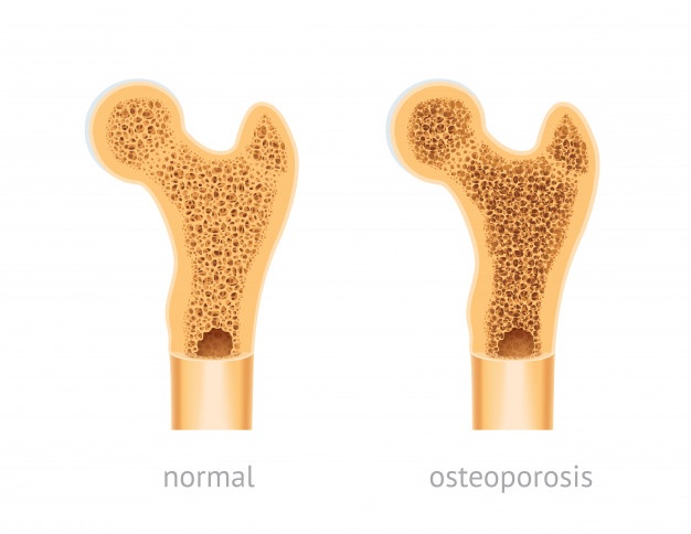 hueso sano osteoporosis humano 196911 162