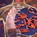 La OMS pide una inversión masiva para frenar la tuberculosis