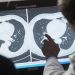 Mayor gasto de EE. UU. en cáncer no mejora la tasa de sobrevivencia, dice estudio