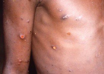 ¿Qué es la viruela del mono, cómo se contagia y cómo prevenirla?