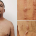 Detienen en Santa Ana a el «Vago», pandillero que intentó quemar sus tatuajes para ocultarlos