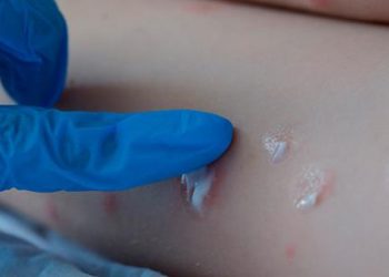 Bolivia activa vigilancia epidemiológica para evitar ingreso de viruela del mono