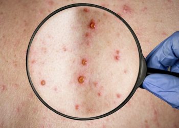 Canadá confirma 235 casos de viruela símica