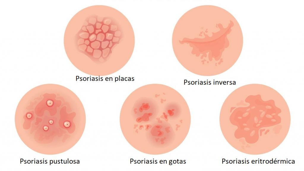 Psoriasis1