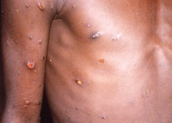 La dermatología de la viruela y cómo evitar sus cicatrices
