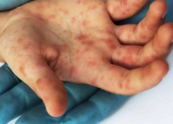OMS evaluará si la viruela del mono representa una «emergencia de salud pública internacional»