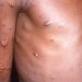 La dermatología de la viruela y cómo evitar sus cicatrices