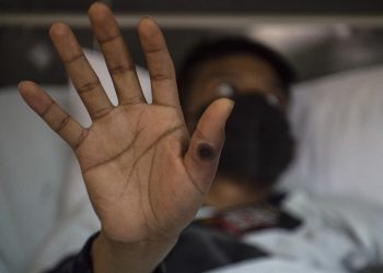 Paciente peruano relata su calvario al contraer la temida viruela del mono