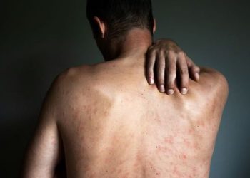 Guatemala confirma tercer casos de viruela símica 