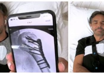 «Se me salió el hueso. Ahí supe que tenía una fractura muy seria», Eugenio Derbez reaparece para contar sobre su accidente