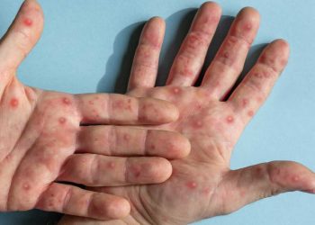 Ascienden a 2,453 casos por viruela del mono en Colombia