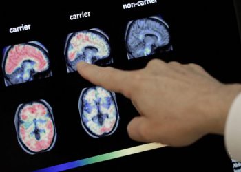 Diagnostican enfermedad de Alzheimer a paciente chino de 19 años de edad