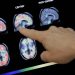Diagnostican enfermedad de Alzheimer a paciente chino de 19 años de edad