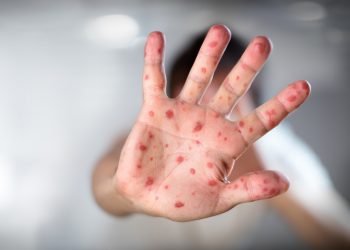 Casos de viruela símica en Paraguay llegan a 125