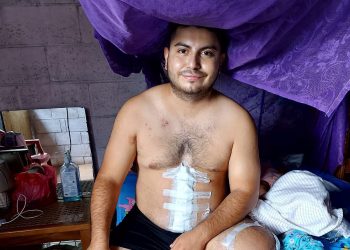 Chef santaneco solicita apoyo tras sufrir accidente