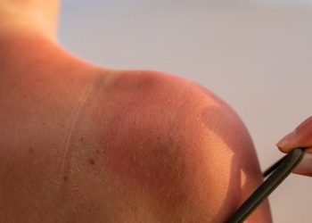 Cáncer de piel: la amenaza del verano y las altas temperaturas