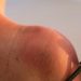 Cáncer de piel: la amenaza del verano y las altas temperaturas