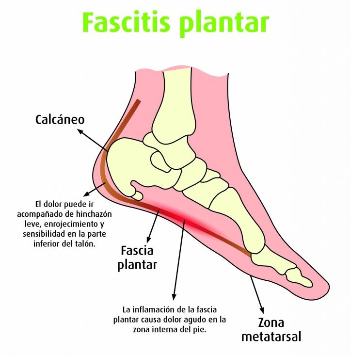fascitis plantar Cinfasalud 724x1024 1