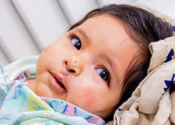 Realizan cirugías de labio leporino y paladar hendido a 25 niños y niñas en el Hospital Bloom