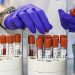 Aumento inquietante de infecciones de transmisión sexual en Europa